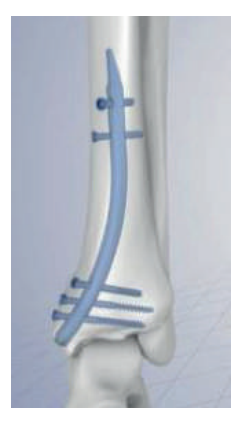 Ретроградний великогомілковий цвях Changzhou Nanxiang Medical Device Co., Ltd.